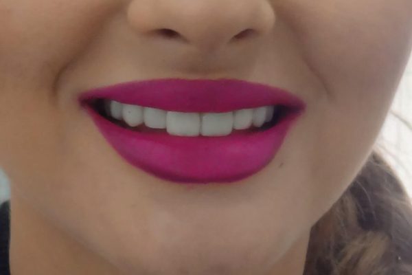 Όψεις Ρητίνης-Bonding