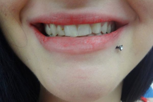 Όψεις Ρητίνης-Bonding