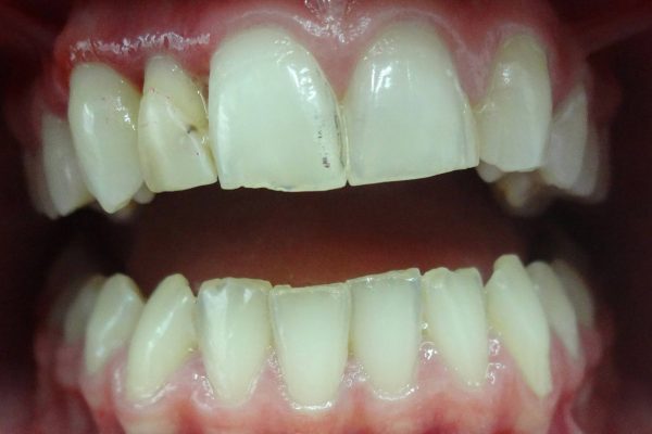 Όψεις Ρητίνης-Bonding