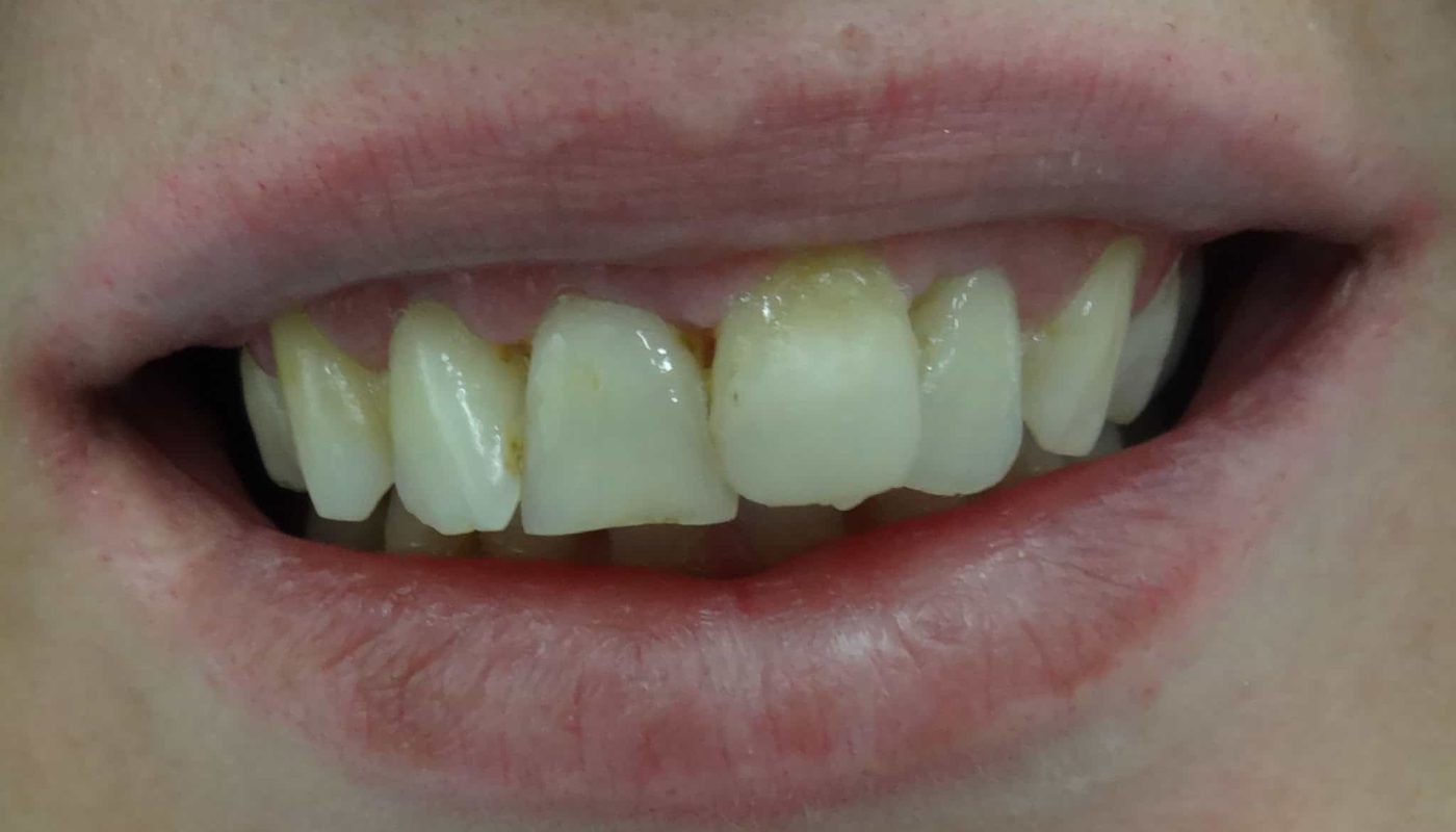 ουλοπλαστική