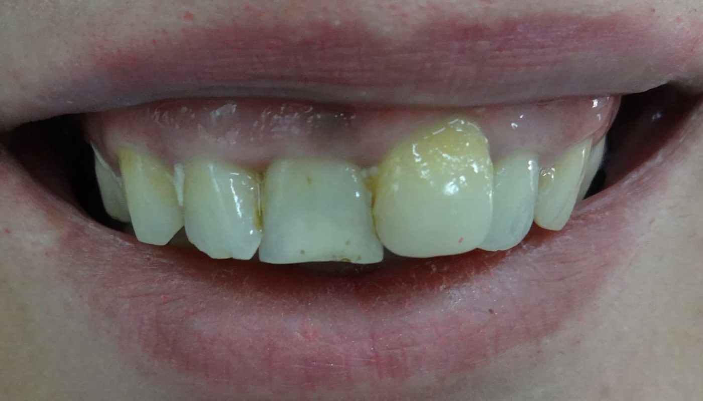 ουλοπλαστική