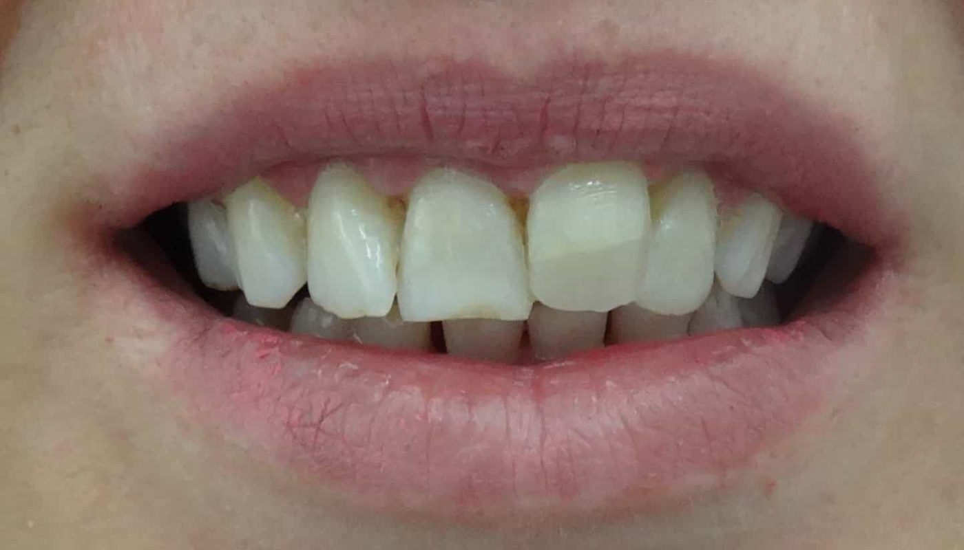 ουλοπλαστική